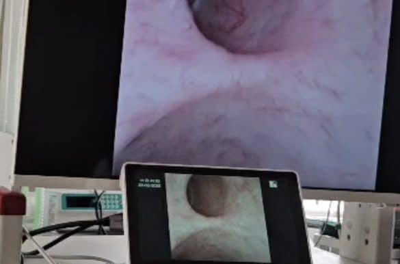 Ureterorenoscopy in Sharab with state-of-the-art equipment